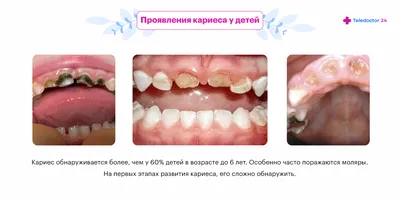 Обзор современных концепций лечения кариеса молочных зубов