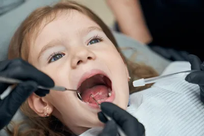 Детская стоматология и ортодонтия в Киеве - блог доктора Пешко Татьяны  Евгеньевны: Альтернатива серебрению зубов у детей