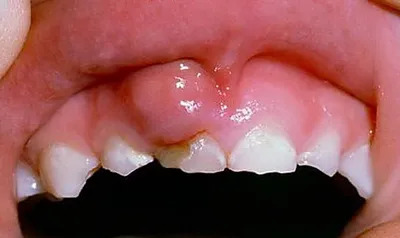 Лечение кариеса в Зеленограде. Цены в стоматологической клинике -  Ортодонт-Премьер