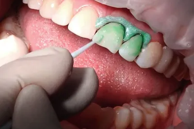 Однократное серебрение зубов защитило школьников от кариеса в 80% случаев