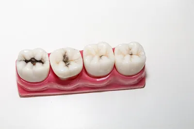 Лечение кариеса передних зубов | Кармэн-Мед