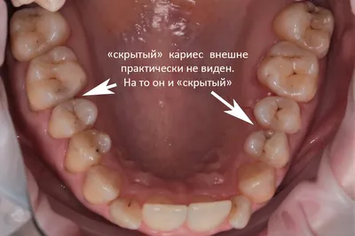 Лечение кариеса в Москве: цена удаления кариеса зубов в стоматологии Lotus  Dent