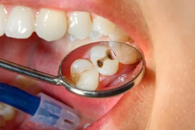 Лечение зубов от кариеса и установка пломб в Москве