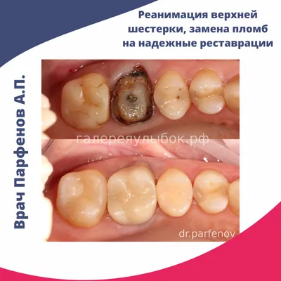 Кариес между зубами 90% - это... - Yormand.dentalclinic | Facebook