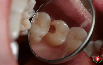 Лечение зубов в Самаре: кариес и его осложнения - Клиника Сатори