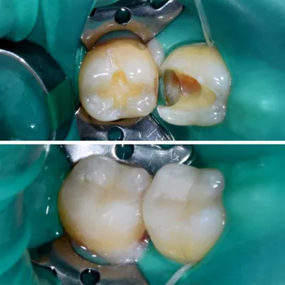 Кариес внутри зуба | Лечение зубов - Врач стоматолог-терапевт Филатова П.А.  | Лечение зубов (до/после) | Наши работы