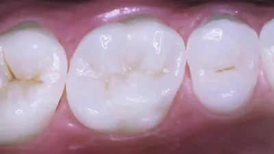 Лечение зубов - Врач стоматолог-терапевт Филатова П.А.