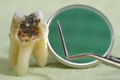 Лечение кариеса в Москве, цены на лечение кариеса зубов в стоматологии  «DentBerg»