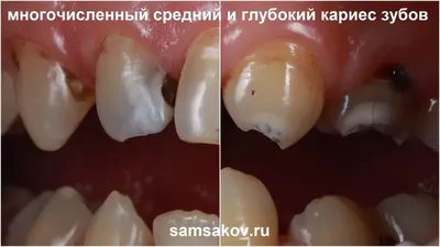 Терапия. Кейс №13. Высокоэстетичные реставрации зубов - примеры работ  стоматологии KANO