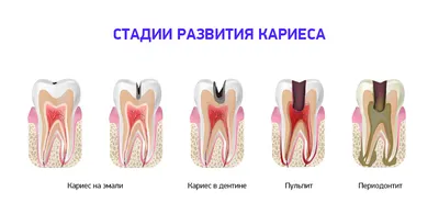 ≡ Лечение кариеса зубов в Киеве — метро Олимпийская: цены в клинике D.Ante