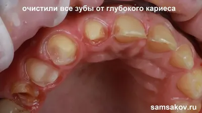 Лечение острого пульпита зубов в стоматологии в Москве