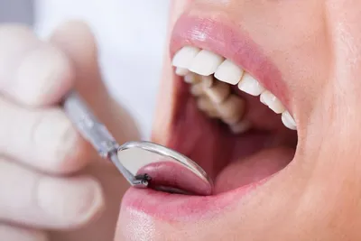 Диагностика и лечение кариеса. Реставрация зубов под микроскопом | Цена  лечения в Дентал Мир