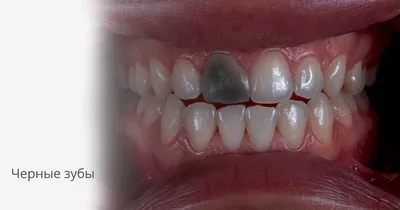 Лечение кариеса от 1500 р. Терапевтическое лечение зубов в Краснодаре