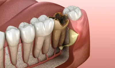 Пришеечный кариес фото, как лечить, причины возникновения | Dental Art