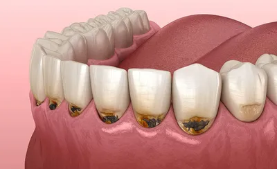 Нужно ли лечить кариес, если зуб не болит? - Стоматология «Эталон»