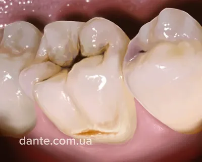 Лечение глубокого кариеса в Москве, цена лечения в стоматологии