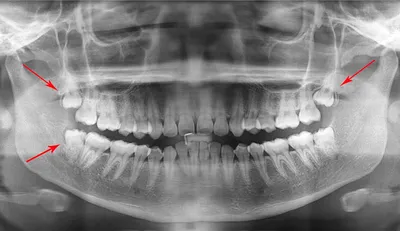 Зуб мудрости — лечить или удалять - энциклопедия Ochkov.net