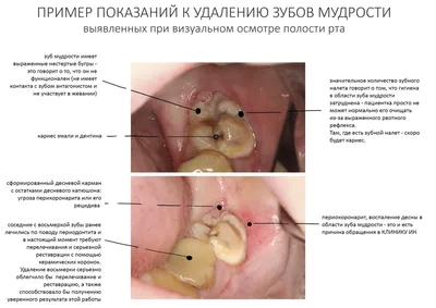 Когда НЕ НУЖНО удалять зубы мудрости? — CLINICIN.RU