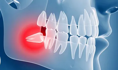 Удаление зуба мудрости: показания, особенности, осложнения — Статьи  стоматологии Династия-С