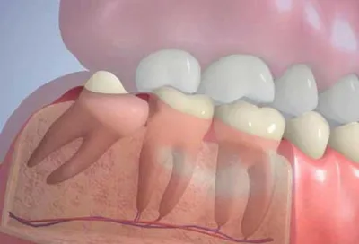 Особенности удаления нижнего зуба мудрости - Стоматология Aliksma