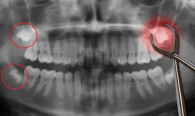 Удаление зуба мудрости. Может, сохраним? | Советы профессионалов  Маэстро-Дент