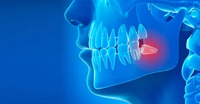 Удаление зубов мудрости. Показания, особенности, осложнения