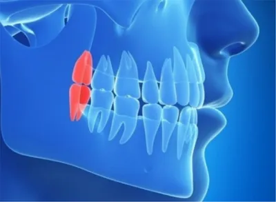 Воспалилась десна около зуба мудрости - Стоматология в Томске