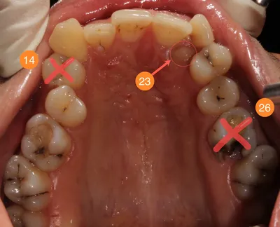 История одной улыбки или рассказ о том как даже «зуб мудрости» пригодился  :: NORD DENTAL — семейная стоматология. Две клиники на севере Петербурга