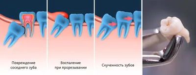 Атравматичное удаление зубов мудрости. Правила и рекомендации.