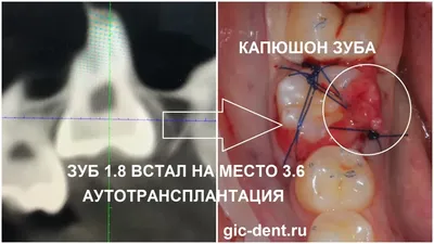 Когда удаление зуба мудрости на нижней челюсти обязательно - Стоматология  Aliksma