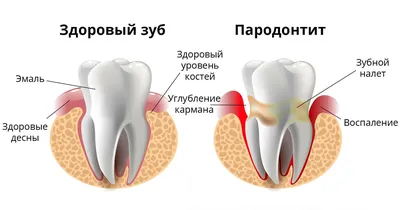 Десневой карман - причины возникновения, методы лечения в Colibri Dental