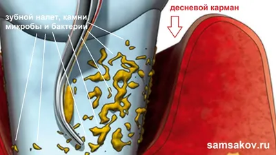 Кюретаж пародонтального кармана десен: открытый и закрытый в стоматологии в  Феодосии