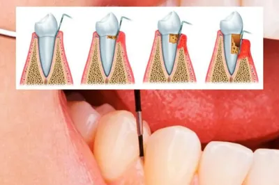 Как лечить десневые карманы наиболее эффективно - Альянс  бьюти-стоматологов, Москва