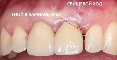 Как лечить десневой карман - Стоматология \"Алекс\" в Жуковском