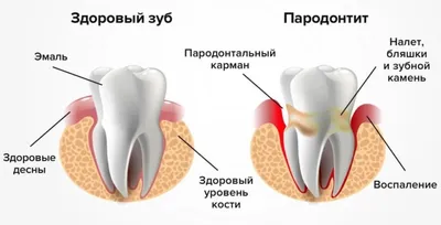 Пародонтоз – что это, как лечить, причины и симптомы