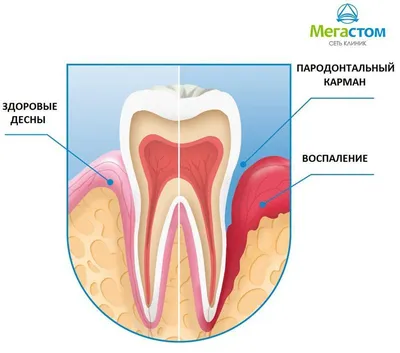 Пародонтит: симптомы и лечение - полезные статьи стоматологической сферы в  блоге «Гелиоса».