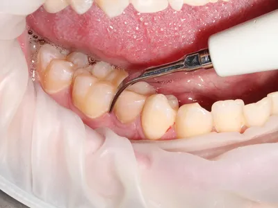 Кюретаж пародонтальных карманов в стоматологии Samara Med (Самара Мед)