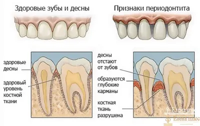 Лечение десневого кармана в Москве - цена от 1000 руб в недорогой  стоматологии MGClinic