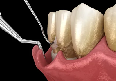 Всё, что нужно знать о пероидонтите