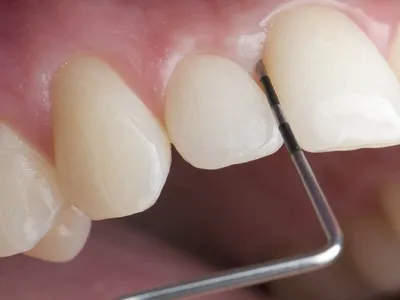 Kечение зубов кюретаж в Спб | MIA DENTAL CLINIC