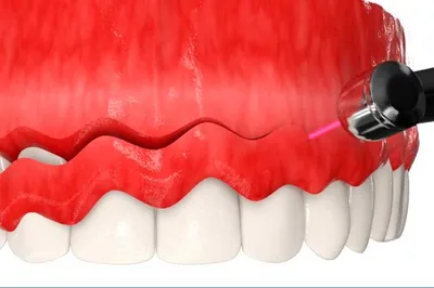 Дистализация 7-го зуба или как подвинуть зуб, чтобы получить место для  имплантата? - блог стоматолога TopSmile