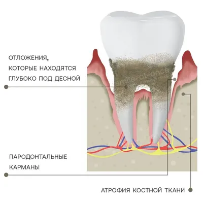 Обработка зубодесневого кармана – статьи стоматологической клиники «Medical  Star»