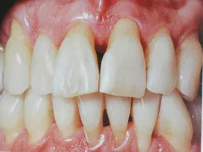 Металлокерамические коронки для зубов и их минусы: фото протезов от  Dominanta74