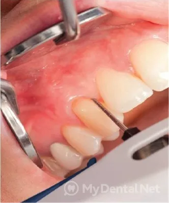 Dental Art Israel מרפאת שיניים - Пародонтоз- дистрофический процесс,  распространяющийся на все структуры пародонта. Его отличительной чертой  является отсутствие воспаления в десне и отсутствие пародонтальных карманов.  Проявляется пародонтоз обнажением ...