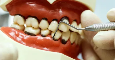 Пародонтит: признаки и лечение – стоматология Президент