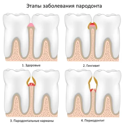 Пародонтит: причины возникновения и лечение — Статьи экспертов стоматологии  Династия-С в Ростове-на-Дону