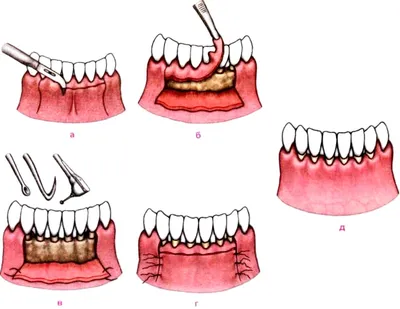 Кюретаж пародонтальных карманов - Стоматология \"Дантист\" в Воронеже