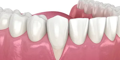 Пародонтит — симптомы и лечение, причины заболевания | Статьи «Клиника  вашего стоматолога»
