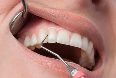 Имплантация зубов при пародонтите в Москве по низкой цене в клинике Новостом