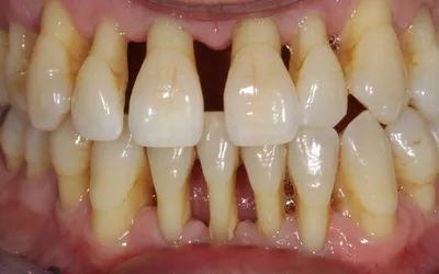 Возможно ли вылечить зубы и костный карман? - Стоматология - Форум  стоматологов (стомотологический форум) - Профессиональный стоматологический  портал (сайт) «Клуб стоматологов»